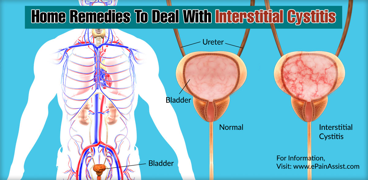 Home Remedies To Deal With Interstitial Cystitis