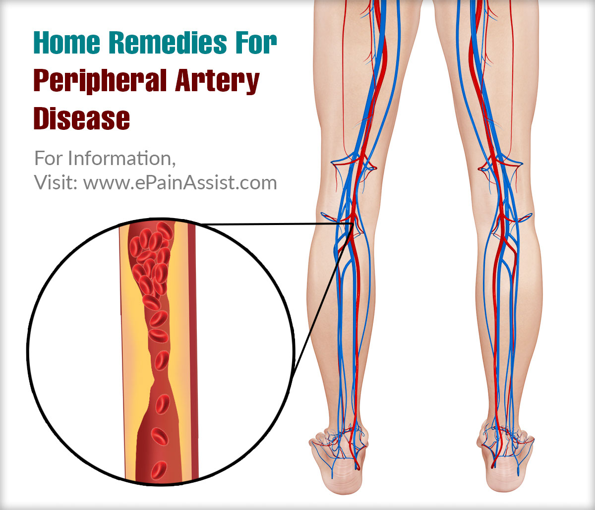 Home Remedies For Peripheral Artery Disease