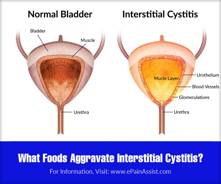 What Foods Aggravate Interstitial Cystitis & What Foods Calm It?