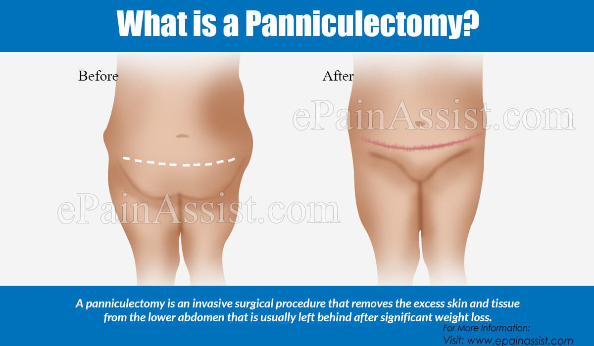 What is a Panniculectomy?