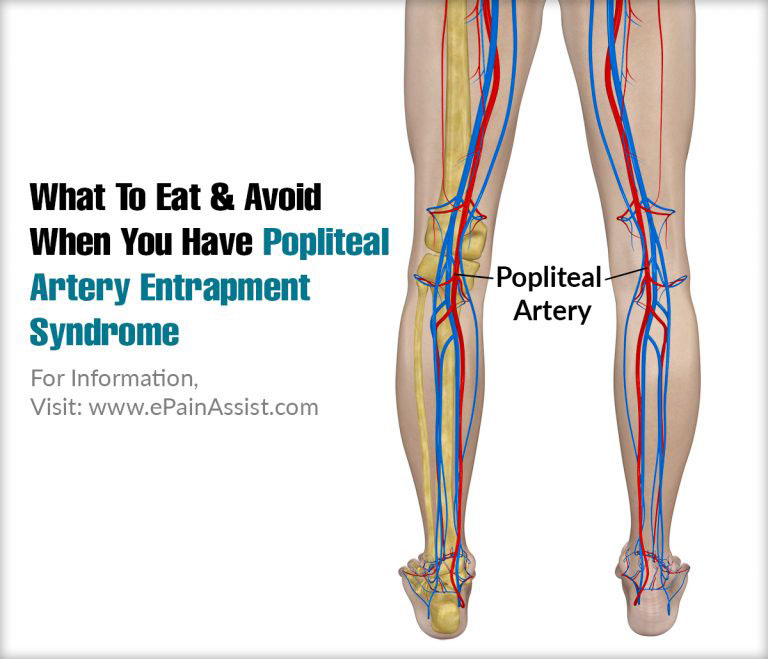 What To Eat & Avoid When You Have Popliteal Artery Entrapment Syndrome?