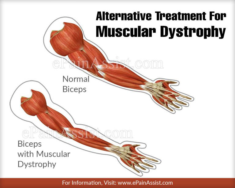 Alternative Treatment For Muscular Dystrophy