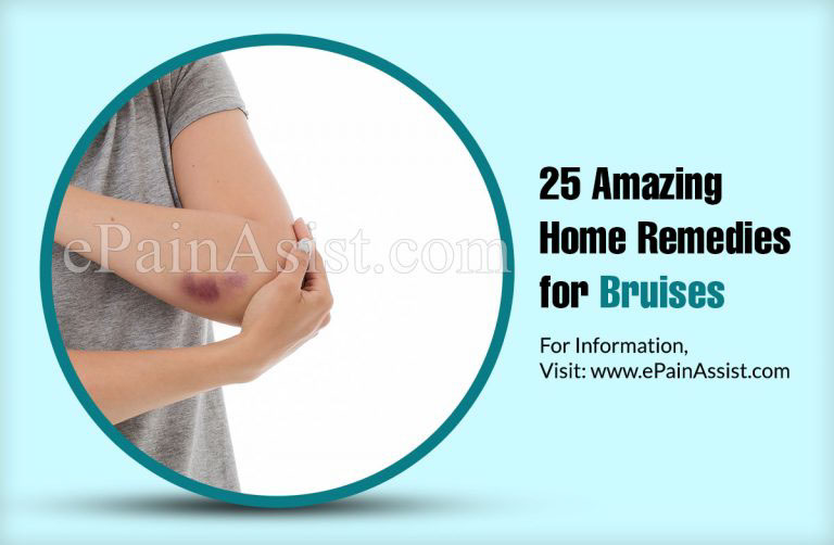 25 Amazing Home Remedies for Bruises