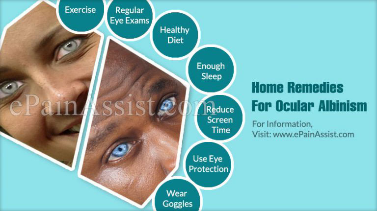 Are There Any Home Remedies For Ocular Albinism?