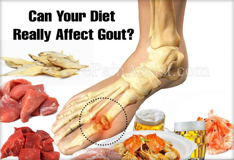 Diet for Gout:  Foods to Eat & Avoid, Foods to Eat in Moderation if You Have Gout