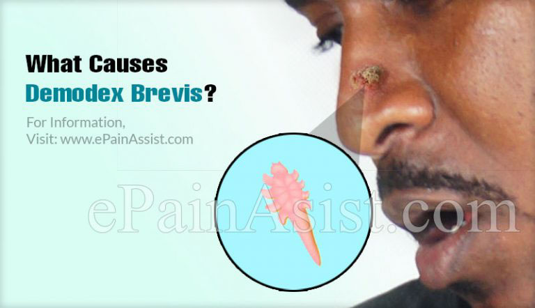 Demodex Brevis: Causes & Treatment
