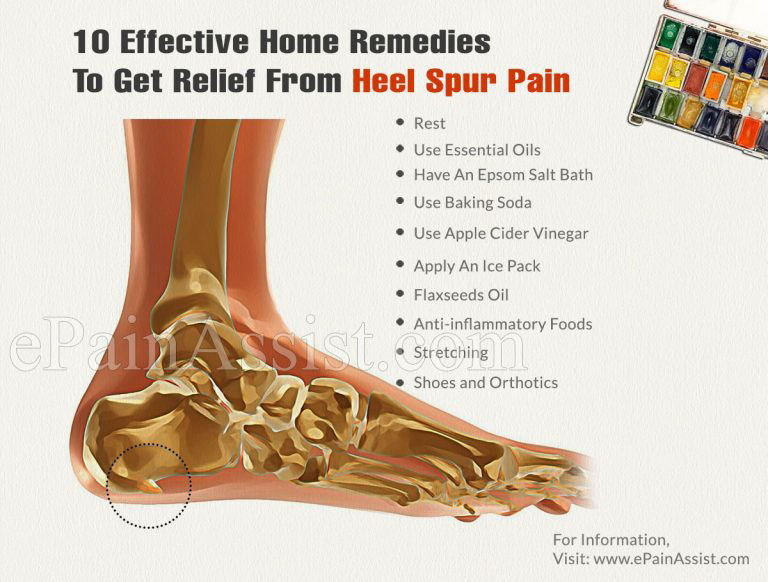 10 Effective Home Remedies To Get Relief From Heel Spur Pain