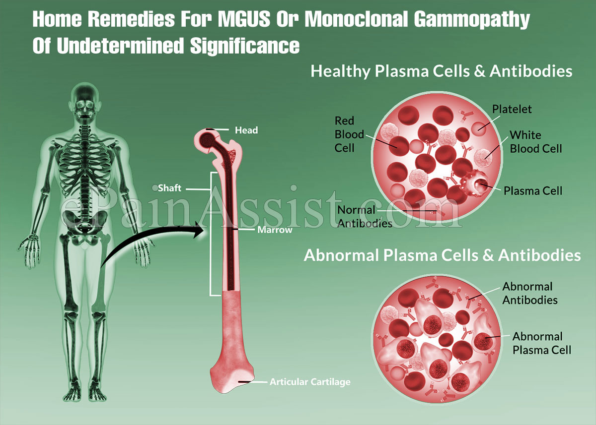 Home Remedies For MGUS or Monoclonal Gammopathy Of Undetermined Significance