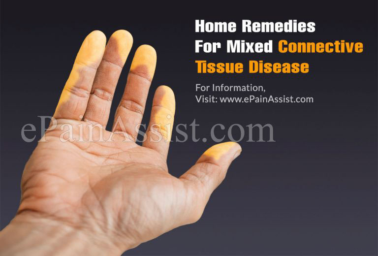 Home Remedies For Mixed Connective Tissue Disease