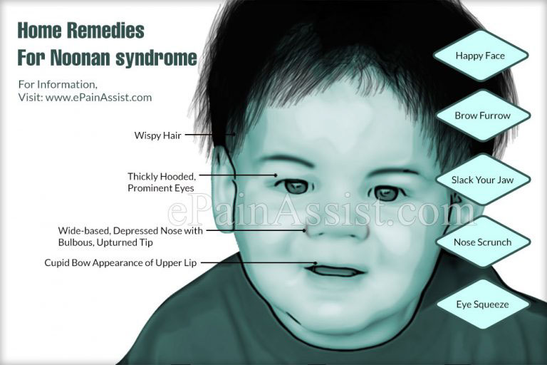 Home Remedies For Noonan syndrome