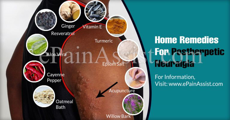 Home Remedies For Postherpetic Neuralgia