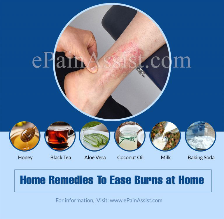 First Aids & Home Remedies To Ease Burns At Home
