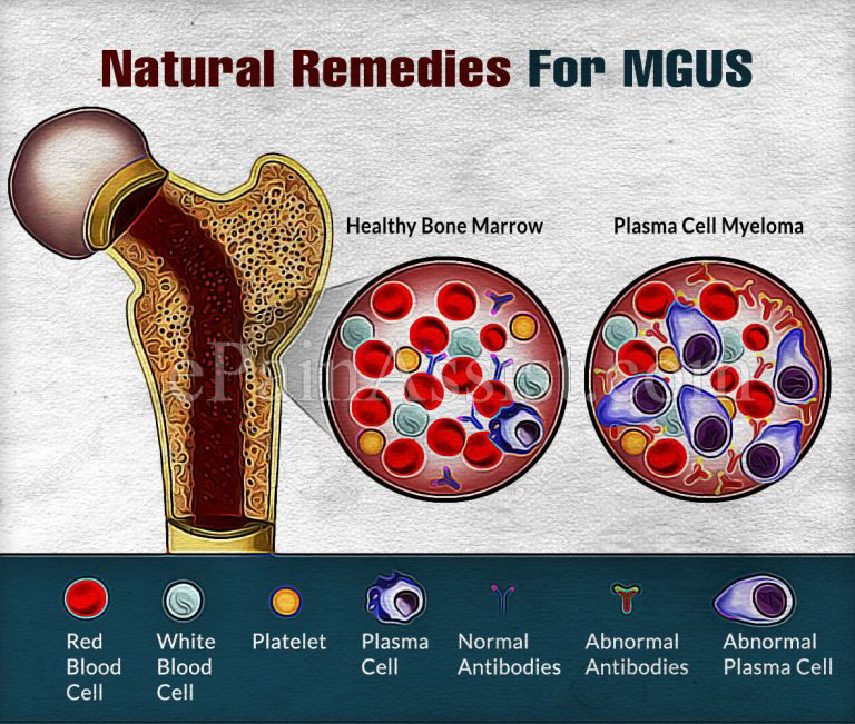 Natural Remedies For MGUS Or Monoclonal Gammopathy Of Undetermined Significance