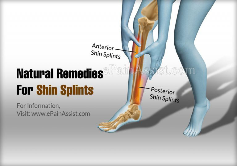 Natural Remedies For Shin Splints