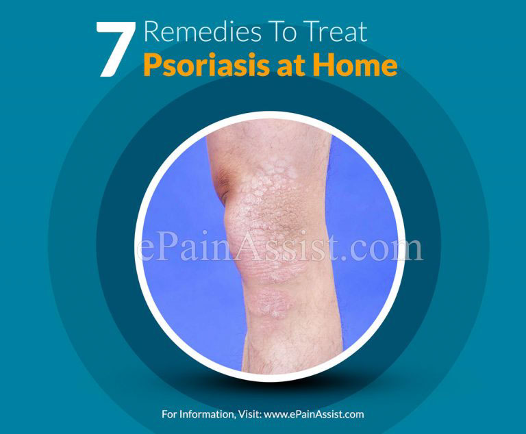 7 Remedies To Treat Psoriasis at Home