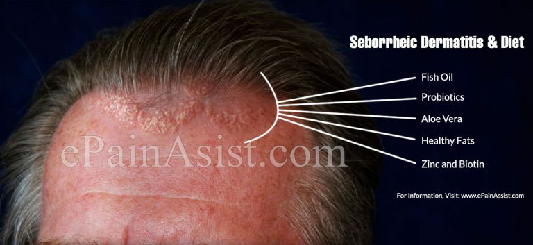 Seborrheic Dermatitis & Diet: Foods To Eat and Avoid