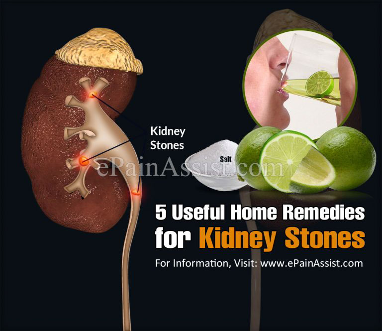 5 Useful Home Remedies for Kidney Stones