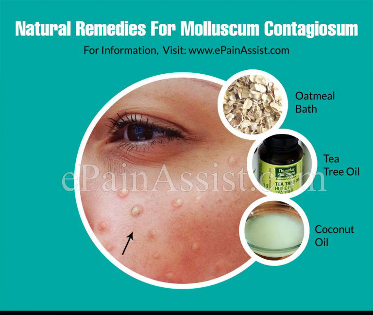 What Are The Natural Remedies For Molluscum Contagiosum?