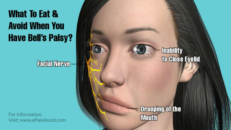 What To Eat & Avoid When You Have Bell’s Palsy?