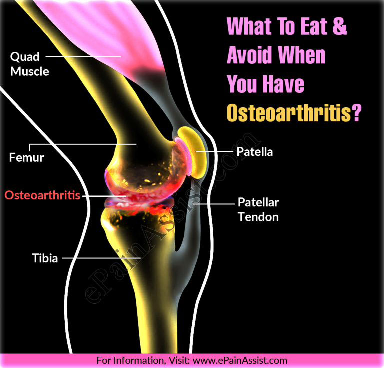 What To Eat & Avoid When You Have Osteoarthritis?
