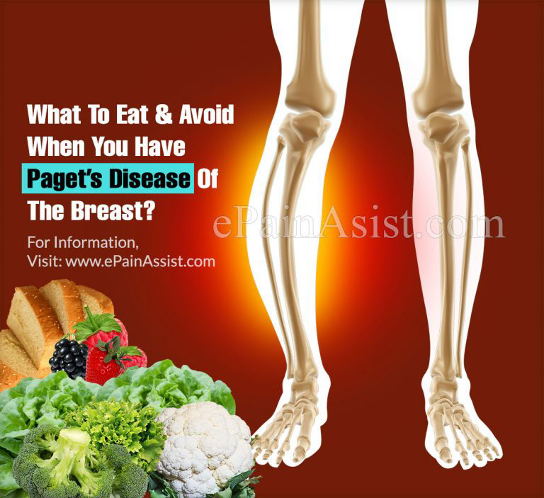 What To Eat & Avoid When You Have Paget’s Disease Of The Breast?