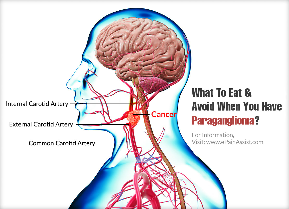 What To Eat When You Have Paraganglioma?