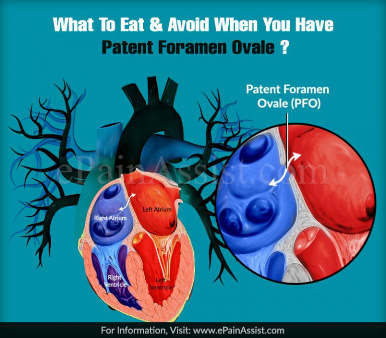 What To Eat & Avoid When You Have Patent Foramen Ovale?