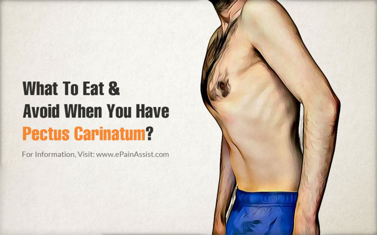 What To Eat & Avoid When You Have Pectus Carinatum?