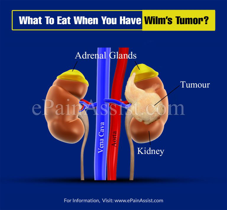 What To Eat And Avoid When You Have Wilm’s Tumor?