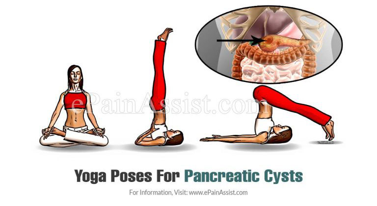 Best Exercises/Activities/Yoga Poses For Pancreatic Cysts