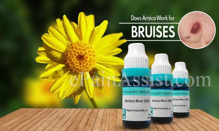 Does Arnica Work for Bruises?