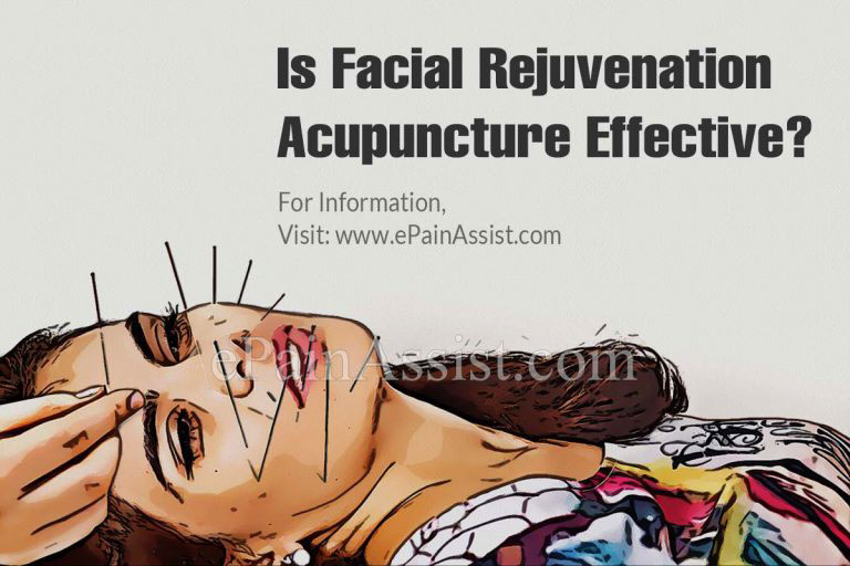 Is Facial Rejuvenation Acupuncture Effective?