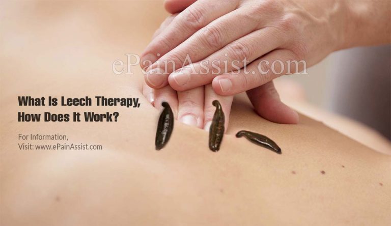 What Is Leech Therapy, How Does It Work And Is It Really Effective?