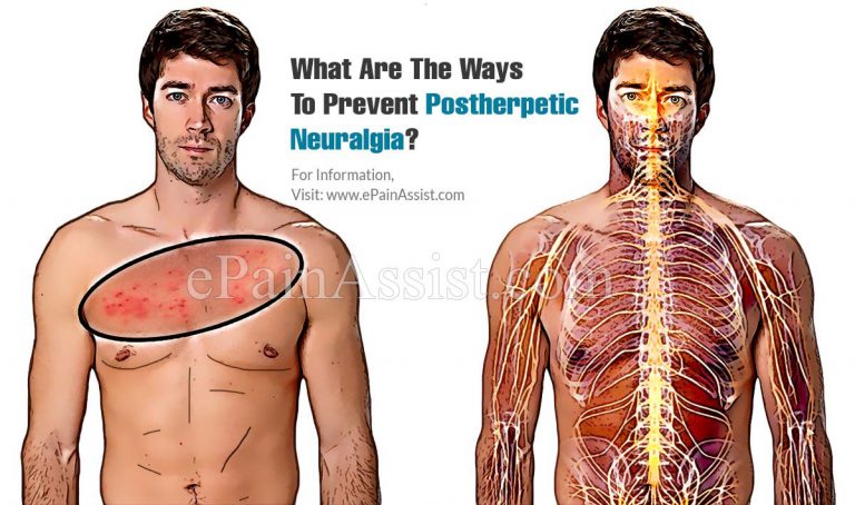 What Are The Ways To Prevent Postherpetic Neuralgia?