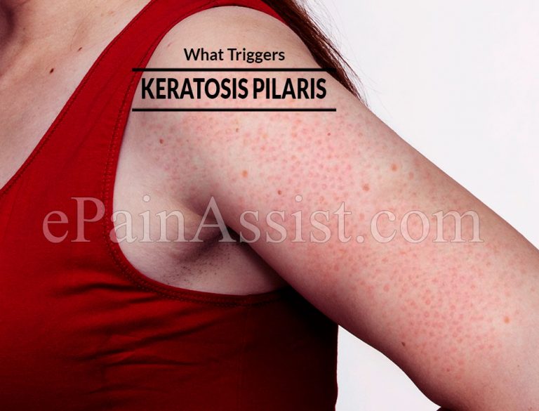 What Triggers Keratosis Pilaris & How Long Does Keratosis Pilaris Last?