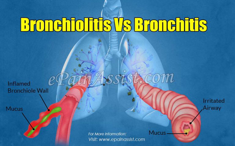 Bronchiolitis Vs Bronchitis: Differences Based on Causes, Symptoms, Treatment, Prognosis, Risk Factors and Diagnosis