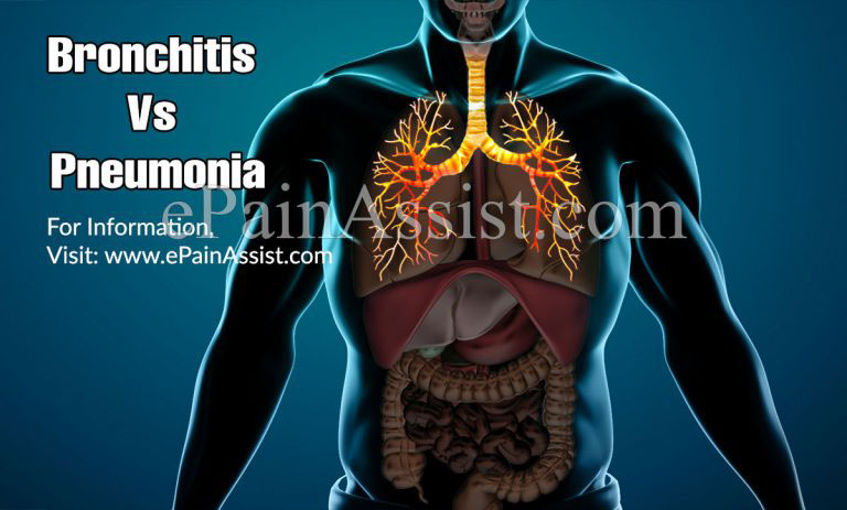 Bronchitis Vs Pneumonia: Differences Based on Types, Causes, Symptoms, Treatment, Prevention, Duration, Prevalence