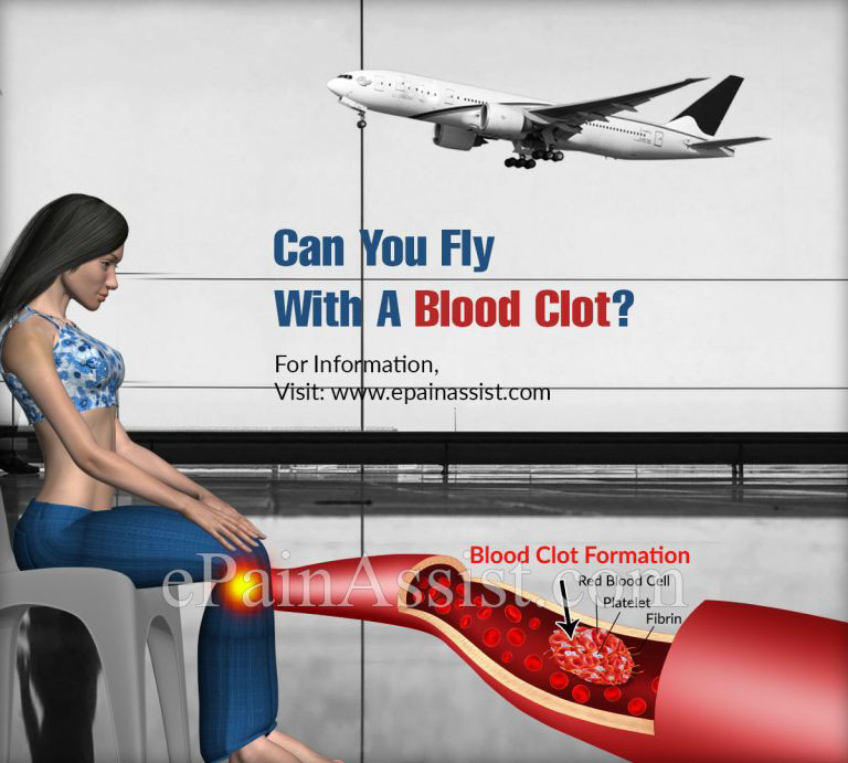 Can You Fly With A Blood Clot & What are the Precautions to be Taken?
