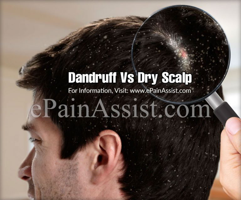Dandruff Vs Dry Scalp: Differences Based on Causes, Symptoms, Treatment