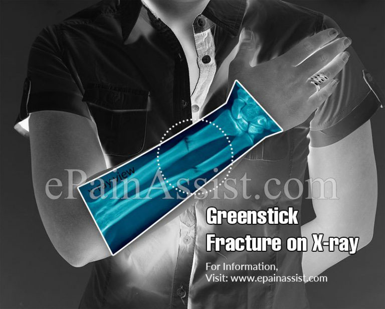 Greenstick Fracture Vs Buckle Fracture : Differences Worth Knowing