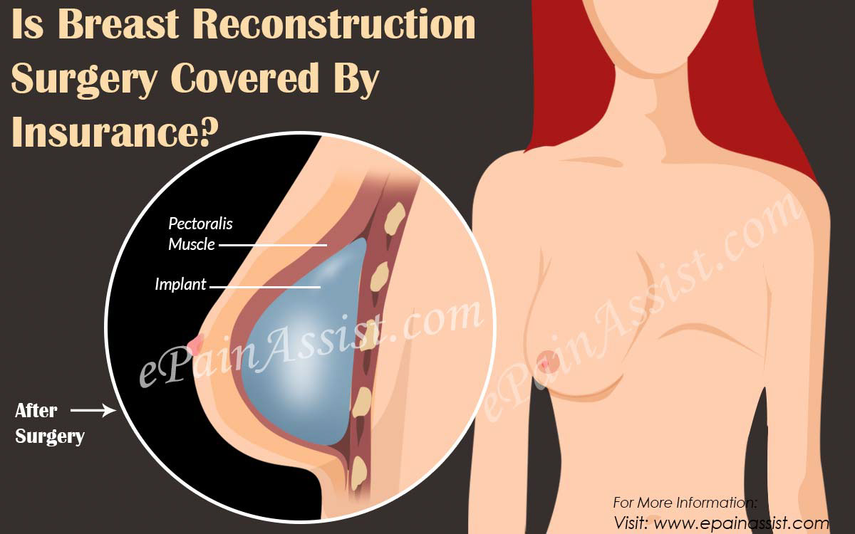 Is Breast Reconstruction Surgery Covered By Insurance?