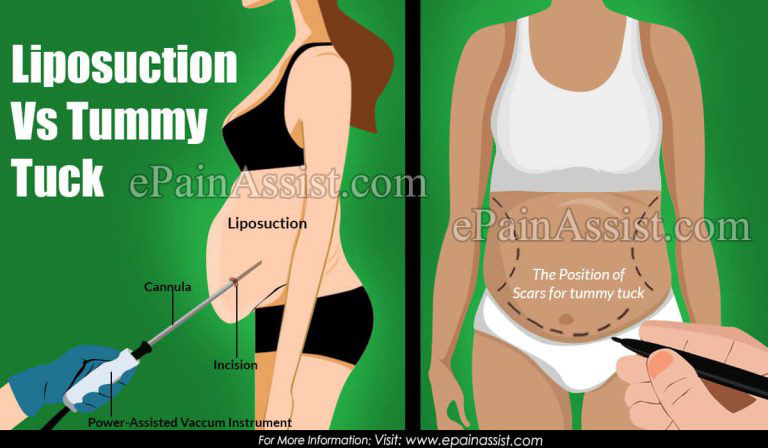 Liposuction Vs Tummy Tuck:  Differences Based on Procedure, Recovery,  Risk, Cost