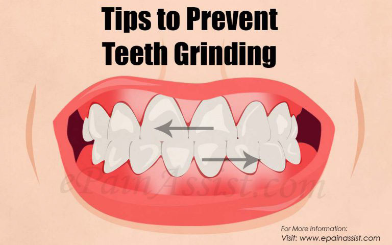 Tips to Prevent Teeth Grinding