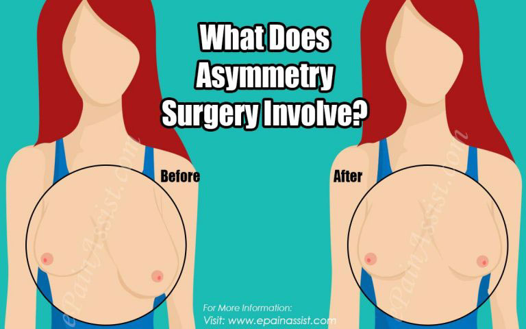 Is Breast Asymmetry Surgery Covered By Insurance?