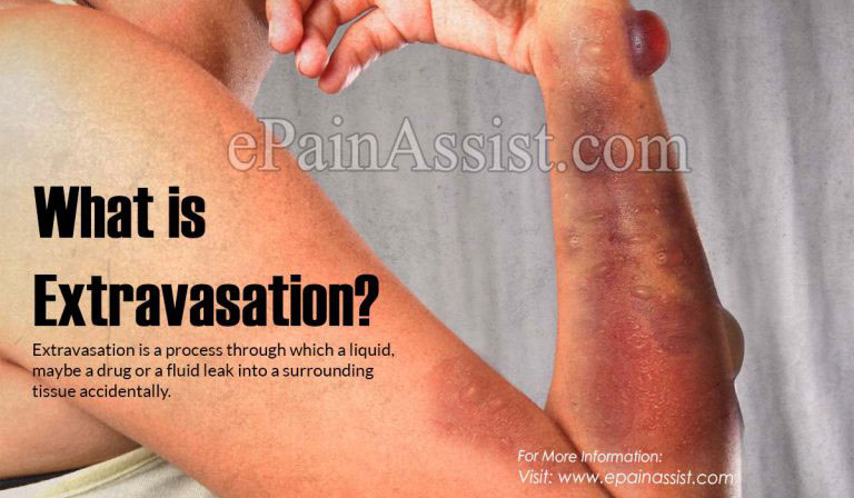Extravasation: Causes, Symptoms, Treatment, Diagnosis
