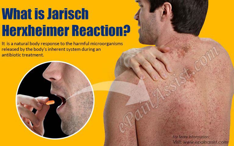 What is Jarisch Herxheimer Reaction & How is it Managed, Prevented?
