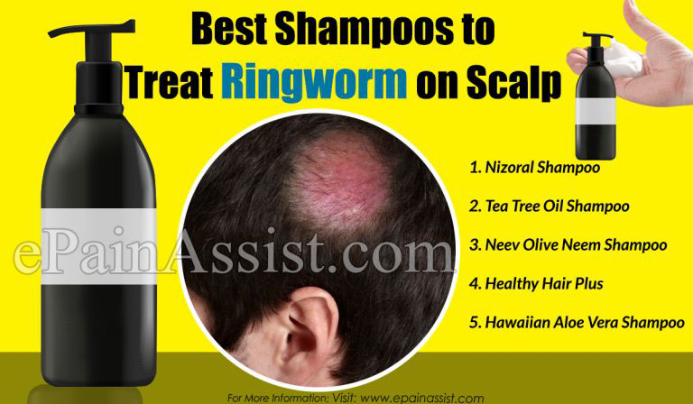Best Shampoo to Treat Ringworm on Scalp