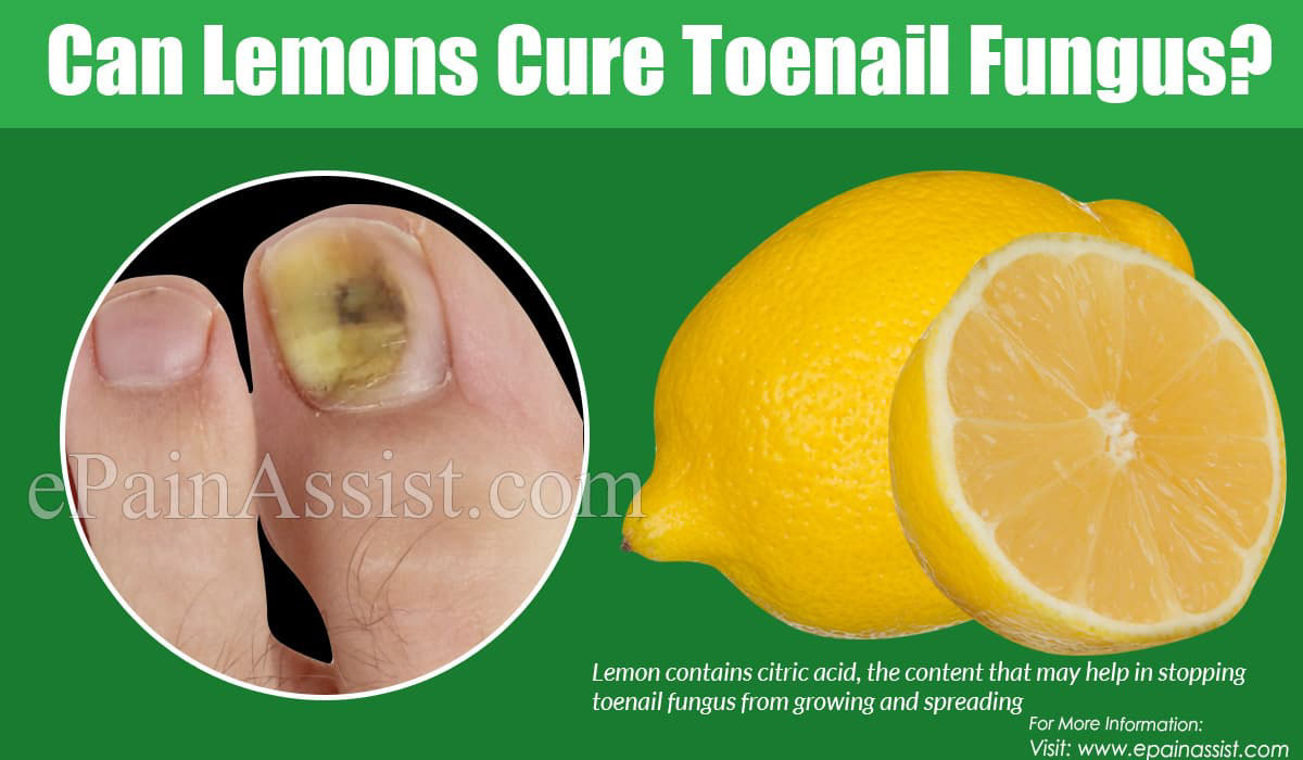 Can Lemons Cure Toenail Fungus?