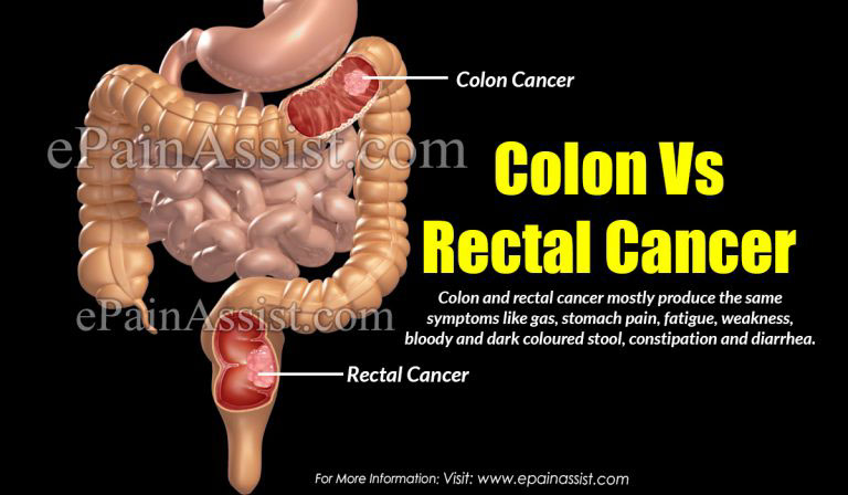 Difference Between Colon and Rectal Cancer Based on Origin of Cancer, its Symptoms, Diagnosis, Treatment