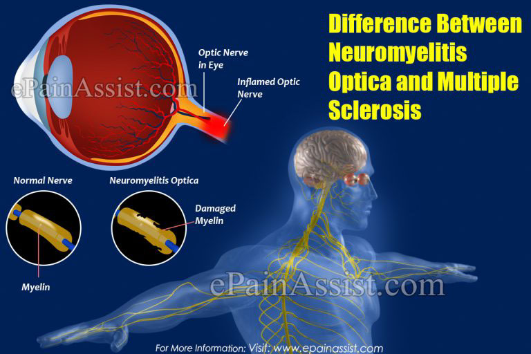 Difference Between Neuromyelitis Optica and Multiple Sclerosis